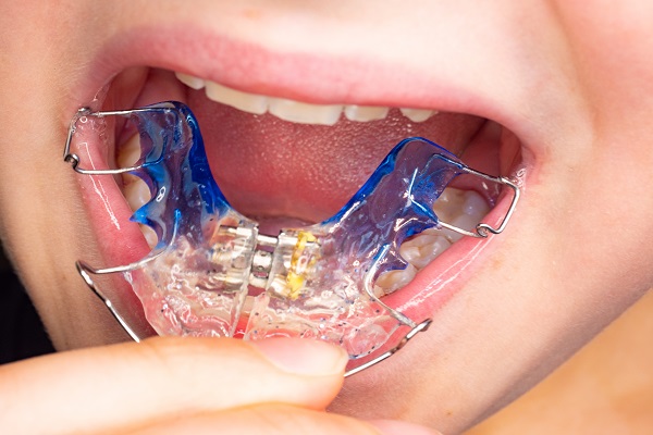 What Are Palatal Expanders In Orthodontics?