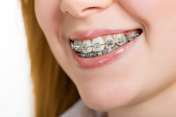 When Would An Orthodontist Recommend Orthodontics For Teens?