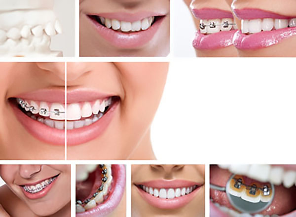 What Are The Different Types Of Braces? Teeth Straightening Options